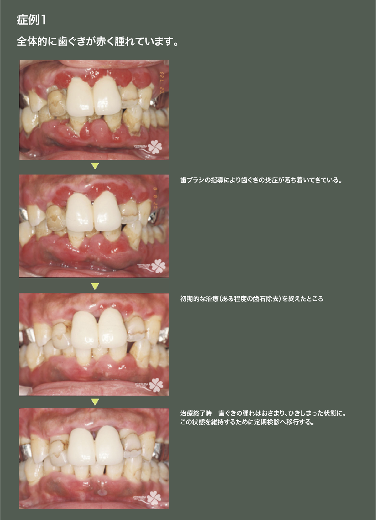 治療 歯 周 病