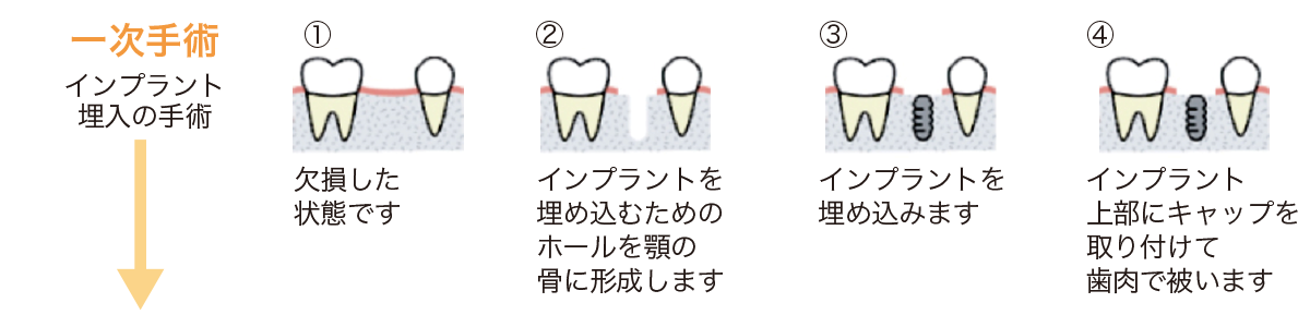 ①欠損した状態です。②インプラントを埋め込むためのホールを顎の骨に形成します。③インプラントを埋め込みます。④インプラント上部にキャップを取り付けて歯肉で被います。