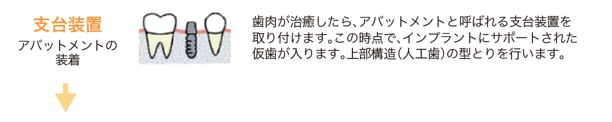 歯肉が治癒したら、アバットメントと呼ばれる支台装置を取り付けます。この時点で、インプラントにサポートされた仮歯が入ります。上部構造（人工歯）の型とりを行います。