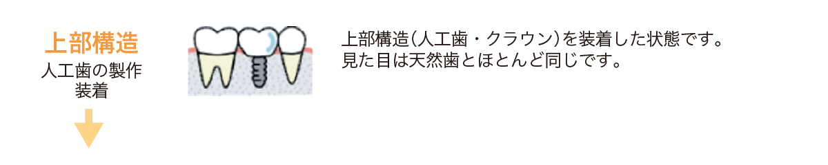 上部構造（人工歯・クラウン）を装着した状態です。見た目は天然歯とほとんど同じです。