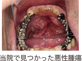 当院で見つかった悪性腫瘍